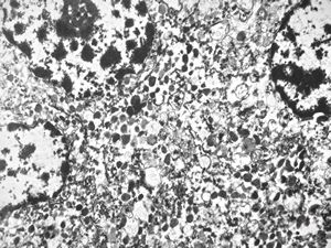 unclassified pancreatic tumor unclassified pancreatic tumor